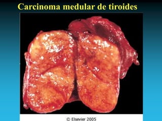 Antonio Ferrández Izquierdo
Carcinoma medular de tiroides
 