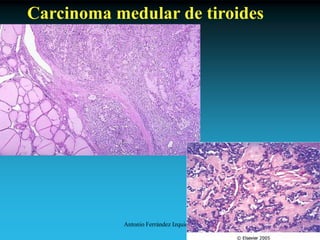 Antonio Ferrández Izquierdo
Carcinoma medular de tiroides
 