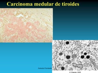 Antonio Ferrández Izquierdo
Carcinoma medular de tiroides
 
