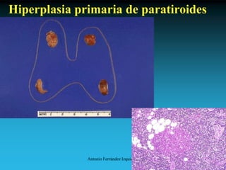 Antonio Ferrández Izquierdo
Hiperplasia primaria de paratiroides
 