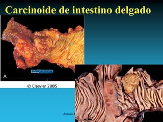 Antonio Ferrández Izquierdo
Carcinoide de intestino delgado
 