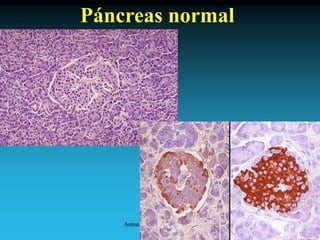 Antonio Ferrández Izquierdo
Páncreas normal
 
