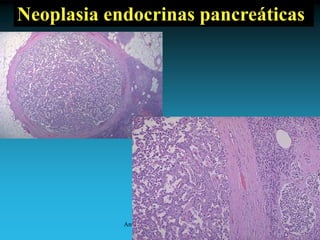 Antonio Ferrández Izquierdo
Neoplasia endocrinas pancreáticas
 