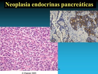 Antonio Ferrández Izquierdo
Neoplasia endocrinas pancreáticas
 