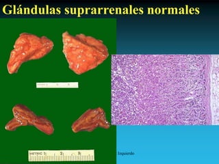 Antonio Ferrández Izquierdo
Glándulas suprarrenales normales
 