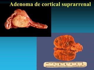 Antonio Ferrández Izquierdo
Adenoma de cortical suprarrenal
 