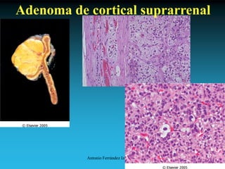 Antonio Ferrández Izquierdo
Adenoma de cortical suprarrenal
 
