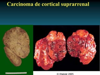 Antonio Ferrández Izquierdo
Carcinoma de cortical suprarrenal
 