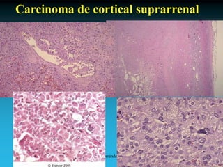 Antonio Ferrández Izquierdo
Carcinoma de cortical suprarrenal
 
