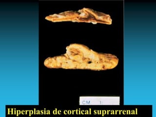 Antonio Ferrández Izquierdo
Hiperplasia de cortical suprarrenal
 
