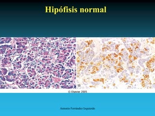 Antonio Ferrández Izquierdo
Hipófisis normal
 