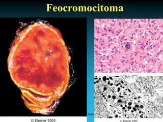 Antonio Ferrández Izquierdo
Feocromocitoma
 