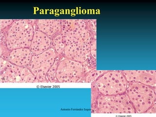 Antonio Ferrández Izquierdo
Paraganglioma
 