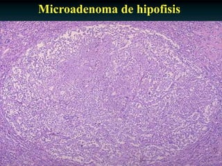 Antonio Ferrández Izquierdo
Microadenoma de hipofisis
 