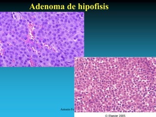 Antonio Ferrández Izquierdo
Adenoma de hipofisis
 