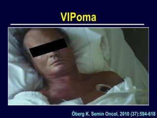 Vipoma Rash Tumores endocrinos del pancreas | PPTX