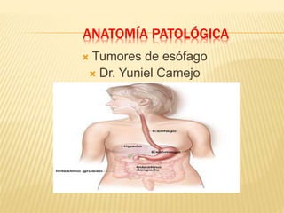 ANATOMÍA PATOLÓGICA
 Tumores de esófago
 Dr. Yuniel Camejo
 