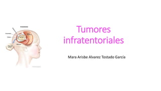 Tumores
infratentoriales
Mara Arisbe Alvarez Tostado García
 