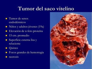 Tumor del saco vitelino
 Tumor de senos
endodérmicos
 Niños y adultos jóvenes (19a)
 Elevación de α-feto proteína
 15 cm. promedio
 Superficie externa lisa y
reluciente
 Quistes
 Focos grandes de hemorragia
 necrosis
 