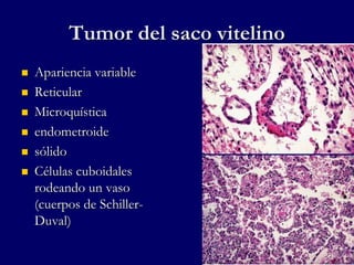Tumor del saco vitelino
 Apariencia variable
 Reticular
 Microquística
 endometroide
 sólido
 Células cuboidales
rodeando un vaso
(cuerpos de Schiller-
Duval)
 
