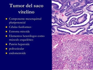 Tumor del saco
vitelino
 Componente mesenquimal
pluripotencial
 Células fusiformes
 Estroma mixoide
 Elementos heterólogos como
músculo esquelético
 Patrón hepatoide
 polivesicular
 endometroide
 