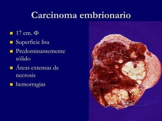 Carcinoma embrionario
 17 cm. Φ
 Superficie lisa
 Predominantemente
sólido
 Áreas extensas de
necrosis
 hemorragias
 