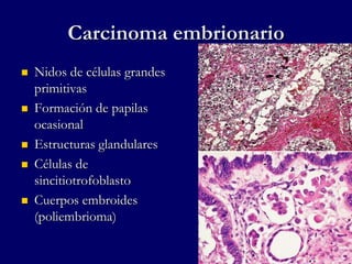 Carcinoma embrionario
 Nidos de células grandes
primitivas
 Formación de papilas
ocasional
 Estructuras glandulares
 Células de
sincitiotrofoblasto
 Cuerpos embroides
(poliembrioma)
 