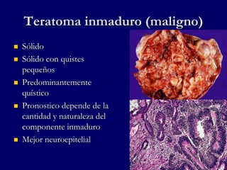 Teratoma inmaduro (maligno)
 Sólido
 Sólido con quistes
pequeños
 Predominantemente
quístico
 Pronostico depende de la
cantidad y naturaleza del
componente inmaduro
 Mejor neuroepitelial
 