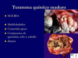 Teratoma quístico maduro
 MACRO:
 Multilobulados
 Contenido graso
 Compuestos de
queratina, sebo y cabello
 dientes
 