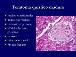 Teratoma quístico maduro
 Implantes peritoneales
 Tejido glial maduro
 Gliomatosis peritonei
 Nódulos blanco-
grisáceos
 Fibrosis
 Inflamación crónica
 Proceso benigno
 