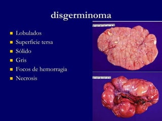 disgerminoma
 Lobulados
 Superficie tersa
 Sólido
 Gris
 Focos de hemorragia
 Necrosis
 