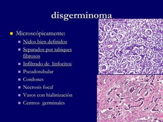 disgerminoma
 Microscópicamente:
 Nidos bien definidos
 Separados por tabiques
fibrosos
 Infiltrado de linfocitos
 Pseudotubular
 Cordones
 Necrosis focal
 Vasos con hialinización
 Centros germinales
 