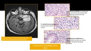 La imagen por resonancia magnética (IRM) es el estudio de elección, y de preferencia con medio de contraste.  Más sensible a cambios en el parénquima, cuando hay hidrocefalia activa, superior a la TAC para visualizar fosa posterior, unión craneovertebral y médula espinal. 
