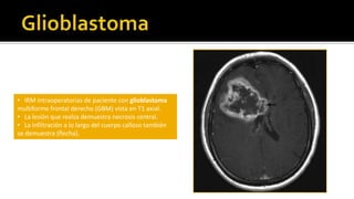        El EEG en pacientes con cefalea la probabilidad de lesión si el EEG es normal es menor a 0.5%. 