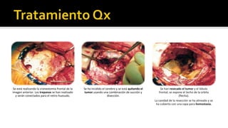        Potenciales evocados- no son específicos.Clasificación Histológica de Tumores de SN