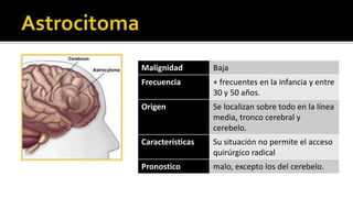 Neoplasias glialesLos signos y síntomas neurológicos que afectan a los pacientes con neoplasias gliales reflejan la localización del tumor y la rapidez con que este crece