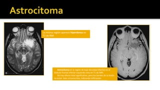 El astrocitromafibrilar se caracterizaporporincremento de la celularidad con poblaciónmonomorfica de celulas de infiltracionEL astrocitromaanaplasico se caracterizaporatipia nuclear y mitosis RM (Obtenidapor FLAIR) Astrocitroma de bajogrado en la region frontotemporalizquierdaEl glioblastomamultiforme se caracterizapor necrosis con celulasdispuestasalrededor del tejidonecrozado. Clasificación Histológica de la OMS