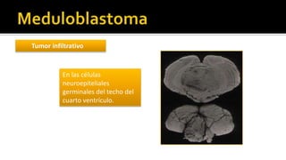 Glioblastoma