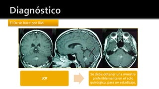 La lesión que realza demuestra necrosis central. 