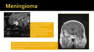 (Cefalea, náuseas, vómitos) Pueden tropezar o caminar de manera torpe o no coordinada. Puede estar afectada el habla y haber nistagmusCuadro Clínico General
