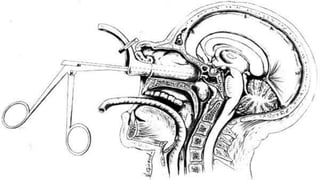 De elección es la cirugía combinada Pronósticodurante 6-7 semanas (son altamente radiosensibles).La dosis se reduce de un 20 a 25 % en niños.(extirpación máxima posible) con radioterapia craneoespinal 35-40 Gy y 10- 15 Gy sobre lecho tumoral Mortalidad operatoria entre el 5 y el 8 %41 % .sobrevida a 5 años.Tratamiento