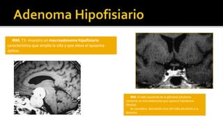 MeningiomaEste meningioma de la convexidad (M) atrofió por presión a la segunda circunvolución frontal izquierda (F2) y precentral o frontal ascendente (FA).( R- Cisura de Rolando)