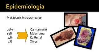 IRM. El lado izquierdo de la glándula pituitaria contiene un microadenoma que aparece hipodenso (flecha).Se considera  desviación leve del tallo pituitario a la derecha.Adenoma HipofisiarioIRM. T1- muestra un macroadenomahipofisiariocaracterístico que amplía la silla y que eleva el quiasma óptico.