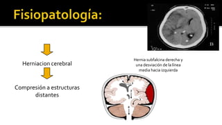Se originan en la división vestibular del VIII par craneal, dentro del conducto auditivo interno. Crecen hacia la fosa posterior, ocupando el ángulo pontocerebeloso y comprimen los pares craneales VII y V y, con menor frecuencia, el IX y el X.Afectan a ambos sexos mayores de 50ª  El 20% con neurofibromatosisII lo padecen. Son benignas, bien encapsuladas.Los síntomas más frecuentes son disminución de la audición, cefaleas, sensación de mareo. Afectación del VIII par, parálisis facial, anormalidades de la marcha y ataxia unilateral de las extremidades.La mielografía de la fosa posterior puede detectar tumores de pequeñas dimensiones.El tratamiento consiste en extirpación quirúrgica del tumor. Neurinoma del acústico