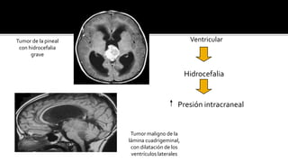 Neurinoma del acústico