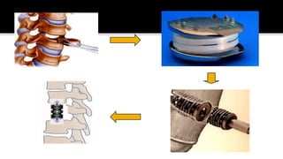 Fisiopatología: Hernia subfalcina derecha y una desviación de la línea media hacia izquierdaHerniacion cerebralCompresión a estructuras distantes 