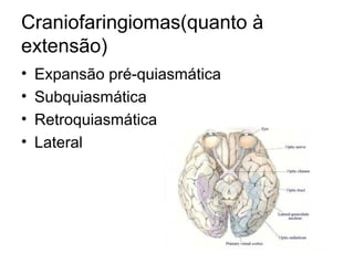 Craniofaringiomas(quanto à 
extensão) 
• Expansão pré-quiasmática 
• Subquiasmática 
• Retroquiasmática 
• Lateral 
 