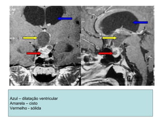 Azul – dilatação ventricular 
Amarela – cisto 
Vermelho - sólida 
 