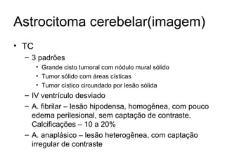 Astrocitoma cerebelar(imagem) 
• TC 
– 3 padrões 
• Grande cisto tumoral com nódulo mural sólido 
• Tumor sólido com áreas císticas 
• Tumor cístico circundado por lesão sólida 
– IV ventrículo desviado 
– A. fibrilar – lesão hipodensa, homogênea, com pouco 
edema perilesional, sem captação de contraste. 
Calcificações – 10 a 20% 
– A. anaplásico – lesão heterogênea, com captação 
irregular de contraste 
 
