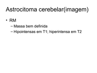 Astrocitoma cerebelar(imagem) 
• RM 
– Massa bem definida 
– Hipointensas em T1; hiperintensa em T2 
 